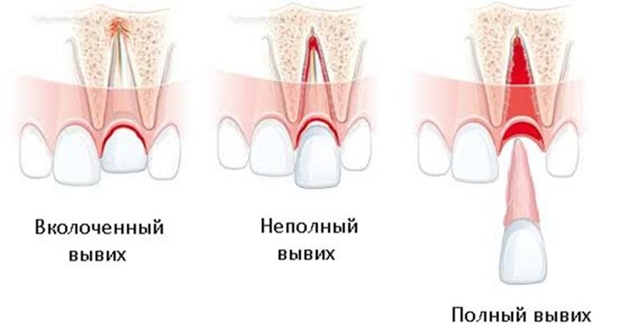Виды вывиха зуба - вколоченный, неполный, полный.