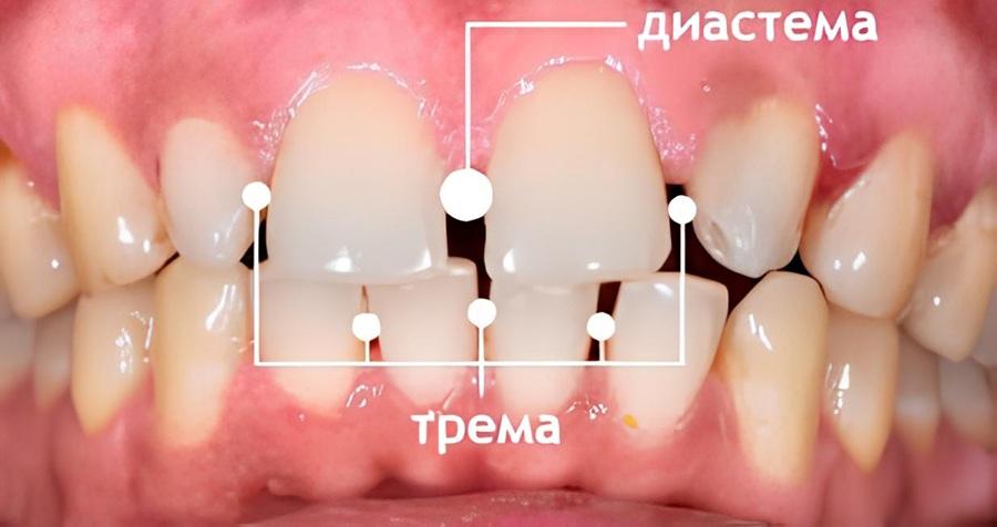 Отличие диастемы от тремы.