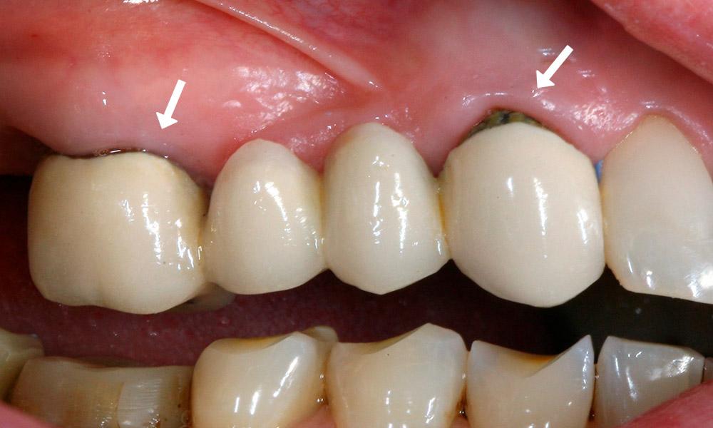 Кариес под искусственной коронкой зуба