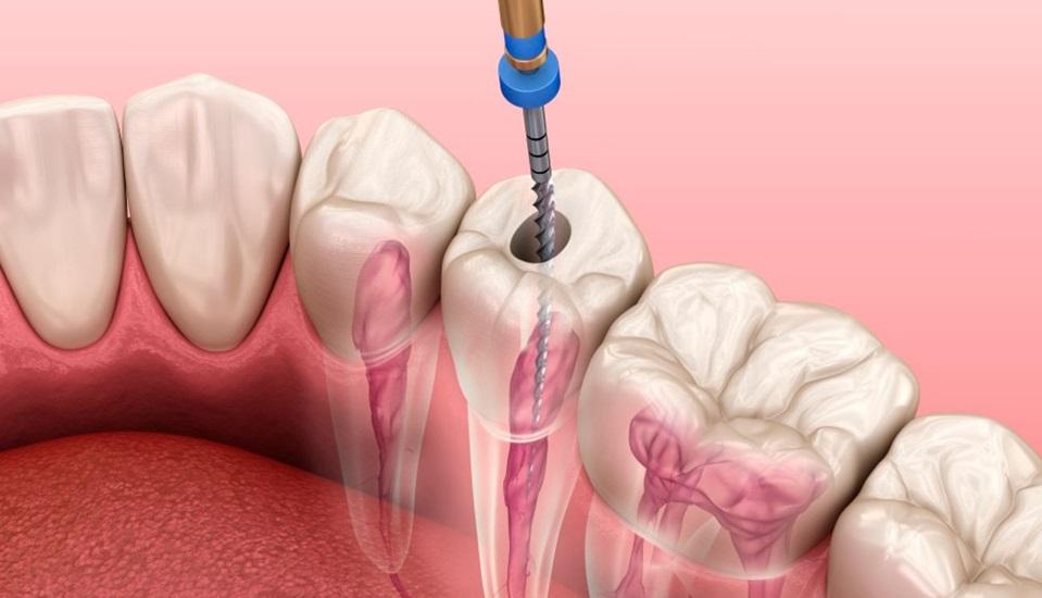 Лечение корневого канала зуба