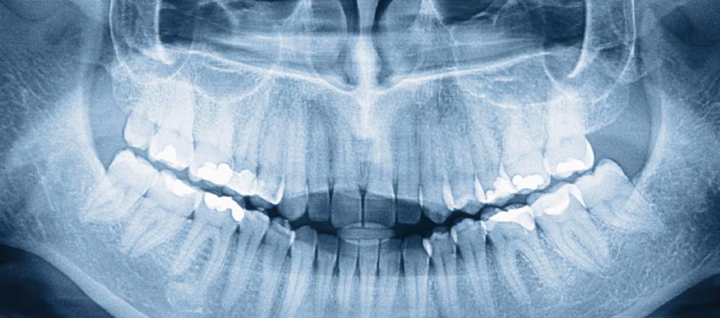 Рентгеновский снимок зубов