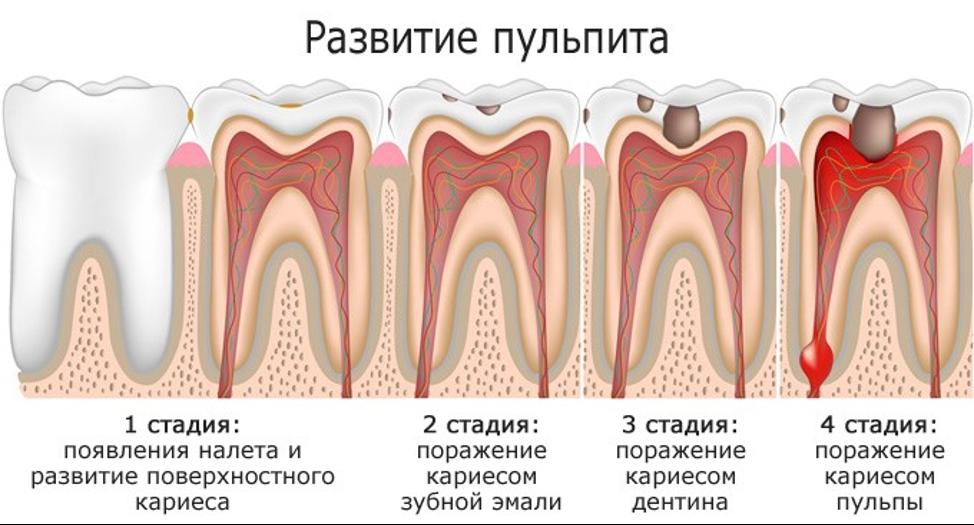 Стадии пульпита