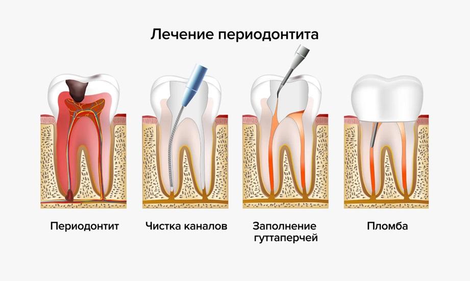 Лечение периодонтита