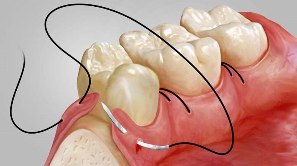Флаповая операция и ушивание десны