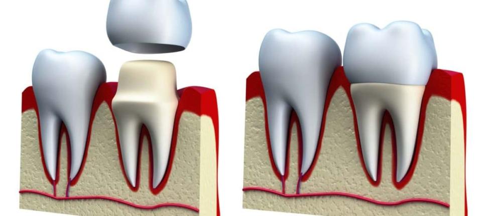 Установка коронки на зуб