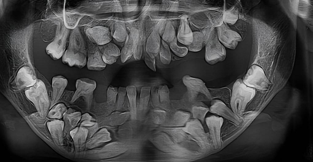 Гипердонтия на рентгеновском снимке