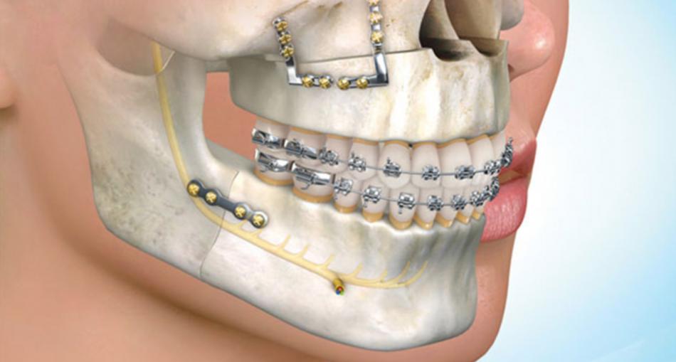Результаты операции на челюсти