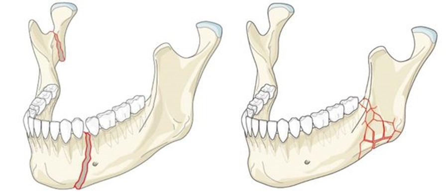 Виды перелома нижней челюсти
