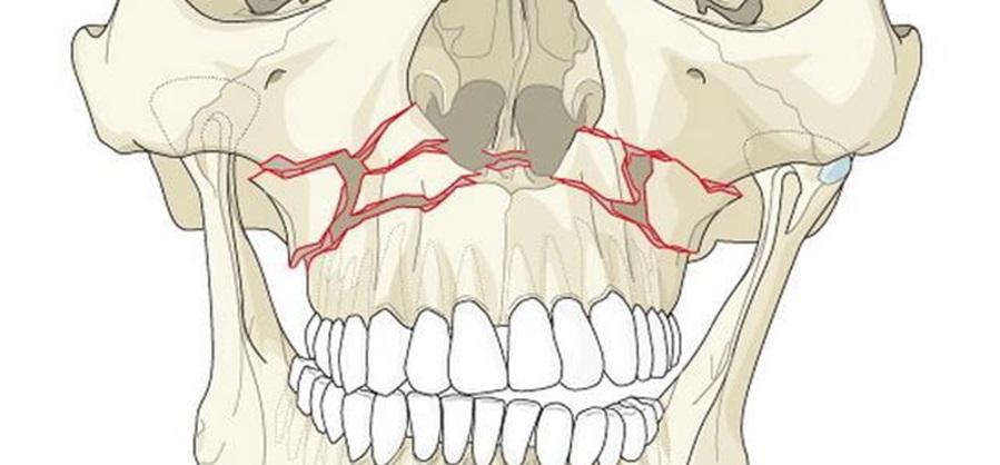 Переломы верхней челюсти