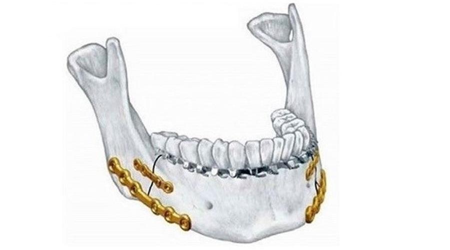 Остеосинтез нижней челюсти