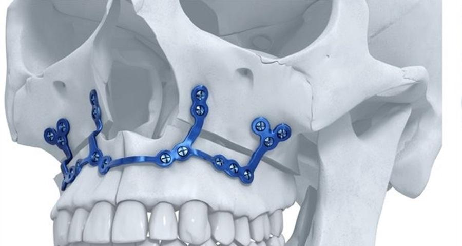 Остеосинтез верхней челюсти
