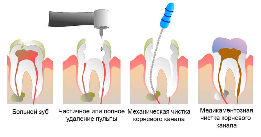 Этапы удаление нерва зуба