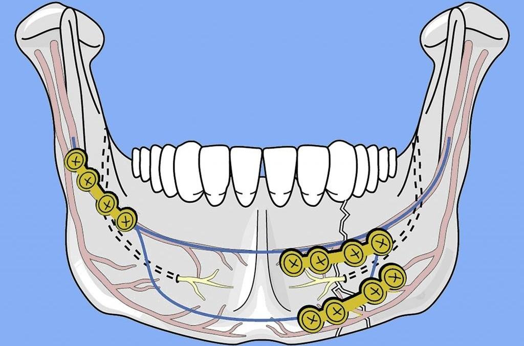 Шинирование челюсти при переломе