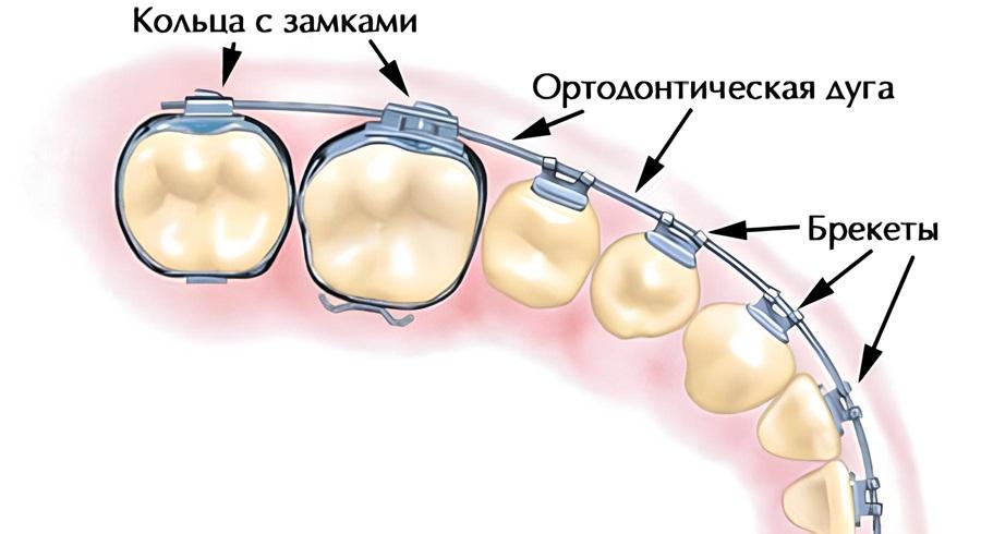 Устройство брекетов.