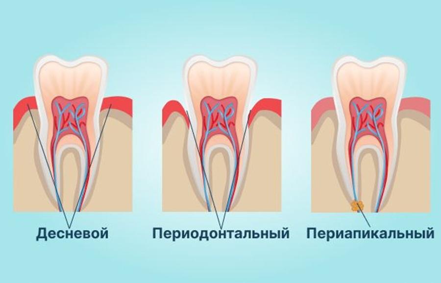 Виды абсцесса зуба.